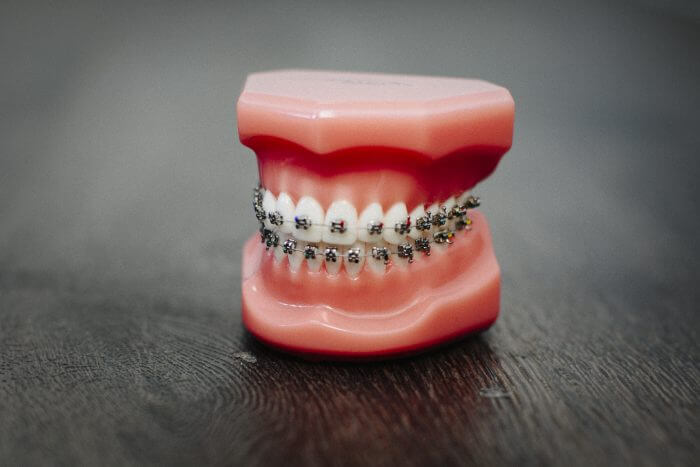 Giải mã những cái được và mất của từng loại hình niềng răng | Nha Khoa Hàn  Quốc
