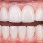 Điều trị răng nhiễm màu Tetracycline bằng giải pháp dán sứ Veneer KHÔNG MÀI RĂNG