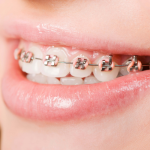 Niềng răng mắc cài kim loại – Giải pháp tối ưu khắc phục khuyết điểm về răng