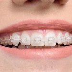 Niềng răng kỹ thuật số phương pháp chỉnh nha tối ưu nhất hiện nay