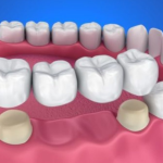 Khắc phục răng mất nhờ kỹ thuật trồng răng sứ với phương pháp cầu răng