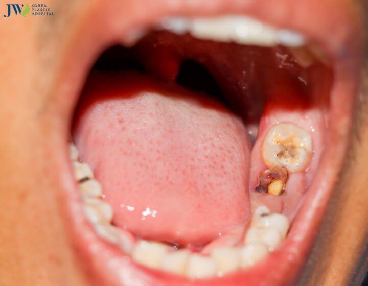 Làm răng sứ có đau không? 2