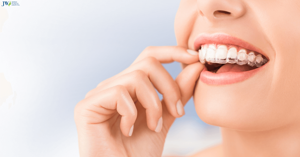 Niềng răng không mắc cài có tốt hơn niềng răng truyền thống