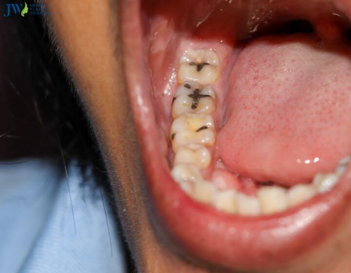 Răng sứ zirconia có tốt không?