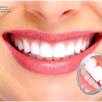 Làm răng sứ có nên tẩy trắng răng? Vệ sinh răng sứ đúng cách