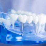 Công nghệ trồng răng Implant AI: Giải pháp hiện đại, an toàn và tiên tiến