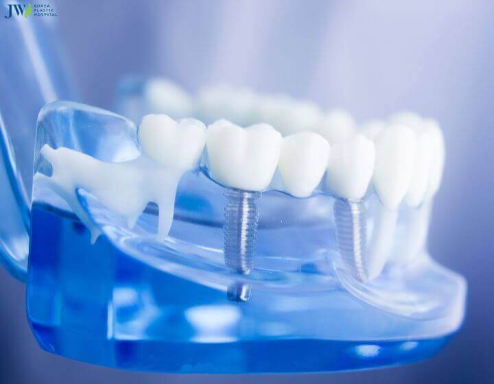Công nghệ trồng răng implant có đau không? 1