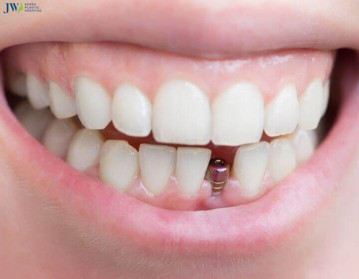 Công nghệ trồng răng implant có đau không? 2