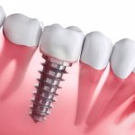 Trồng răng implant công nghệ hiện đại có đau không?