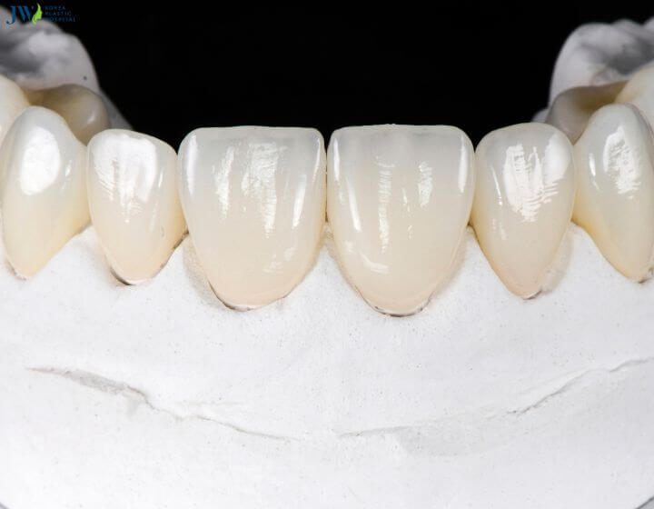Dán răng sứ có hại không? 1