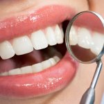 Răng sứ veneer có gây hại không?