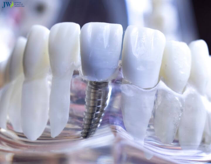 Trồng răng Implant có dùng bảo hiểm được không? 3