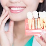 Trồng răng Implant có dùng bảo hiểm được không?