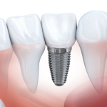 Trồng răng implant có tốt không và chúng tồn tại trong bao lâu?