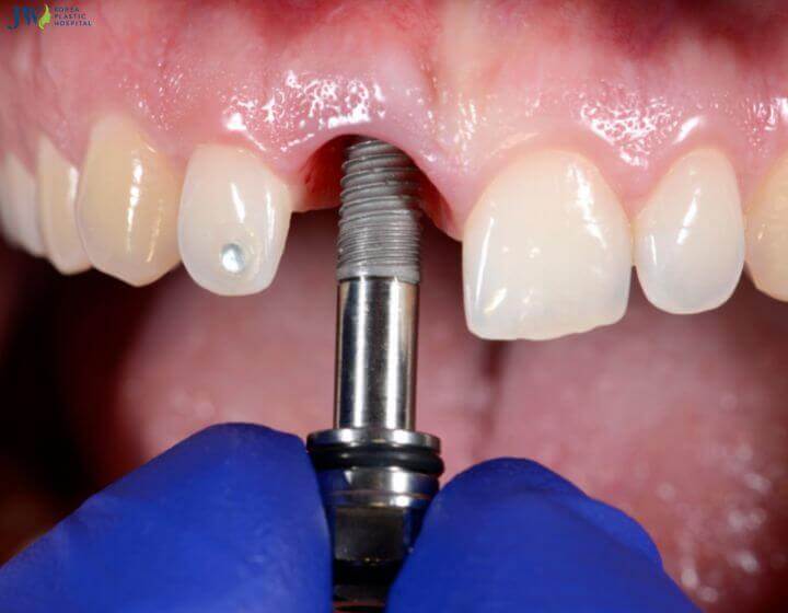 Cấy trụ implant có đau không? Có nên trồng răng implant không? 1