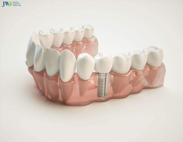 Trồng răng implant có an toàn không? Chăm sóc như thế nào? 2