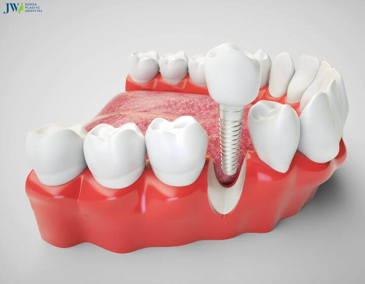Trồng răng implant có bền như quảng cáo không? 1
