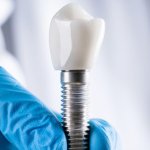 Trồng răng implant có bền như quảng cáo không?