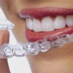 Dịch vụ niềng răng trong suốt AI: 10 lợi ích quan trọng