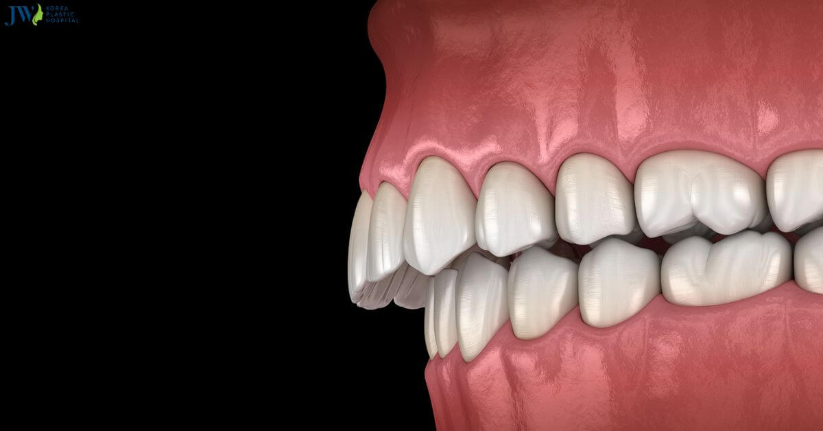 Hô xương ổ răng có nguy hiểm không và cách điều trị? thumb