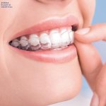 Liệu bạn có đang sử dụng niềng răng trong suốt AI đúng cách chưa?