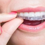 Những loại niềng răng trong suốt bạn cần biết!