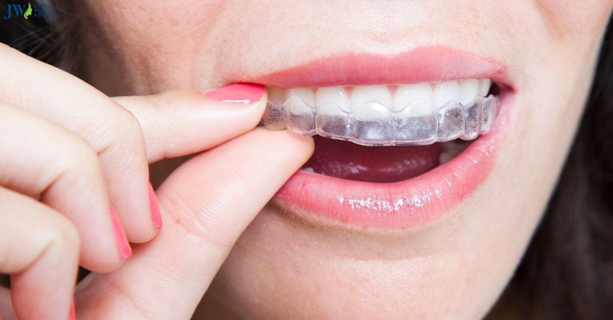 Những loại niềng răng trong suốt bạn cần biết! thumb