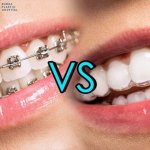 Giải pháp niềng răng là gì và một số lợi ích quan trọng 