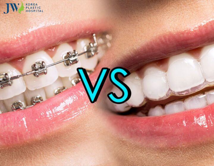 Giải pháp niềng răng là gì và một số lợi ích quan trọng 