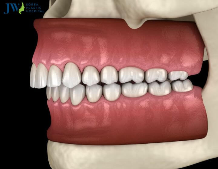 Niềng răng trong suốt AI điều trị răng hô hàm trên có hiệu quả không? 1