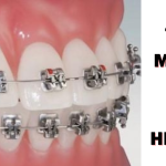 Các loại mắc cài niềng răng mang lại hiệu quả ngày nay