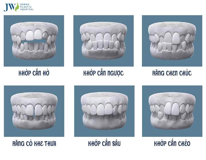 Thời gian điều trị niềng răng trong suốt AI 2