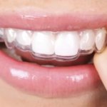 Sử dụng niềng răng trong suốt AI như thế nào đúng cách?