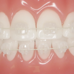 Niềng răng mắc cài sứ trong suốt – Phương pháp chỉnh nha hiện đại