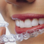 Quy trình niềng răng trong suốt được diễn ra như thế nào?