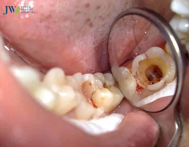 Răng chết tủy có niềng răng được không ?