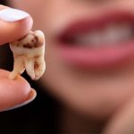 Răng chết tủy có niềng răng được không?