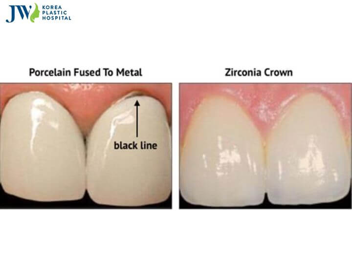 Bọc răng sứ: Khái niệm, phân loại, chi phí 2