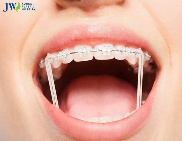 Các loại thun niềng răng phổ biến và tính năng của chúng 3