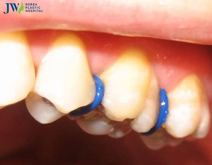 Các loại thun niềng răng phổ biến và tính năng của chúng 4