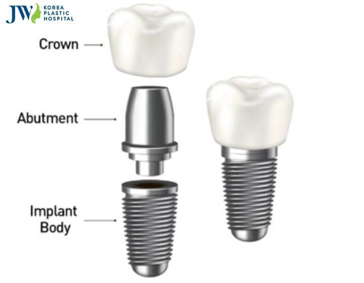 Chi phí trồng răng Implant là bao nhiêu? 1