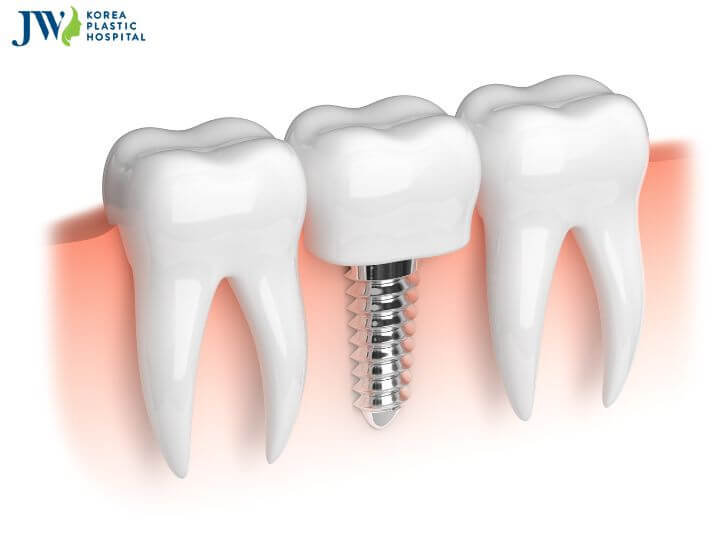 Chi phí trồng răng Implant là bao nhiêu? 2