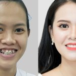 Có thật không: Niềng răng – Phương pháp thay đổi khuôn mặt không cần phẫu thuật?