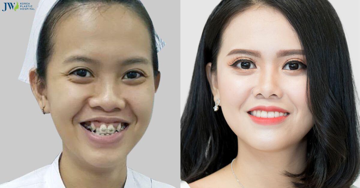 Có thật không: Niềng răng - Phương pháp thay đổi khuôn mặt không cần phẫu thuật?