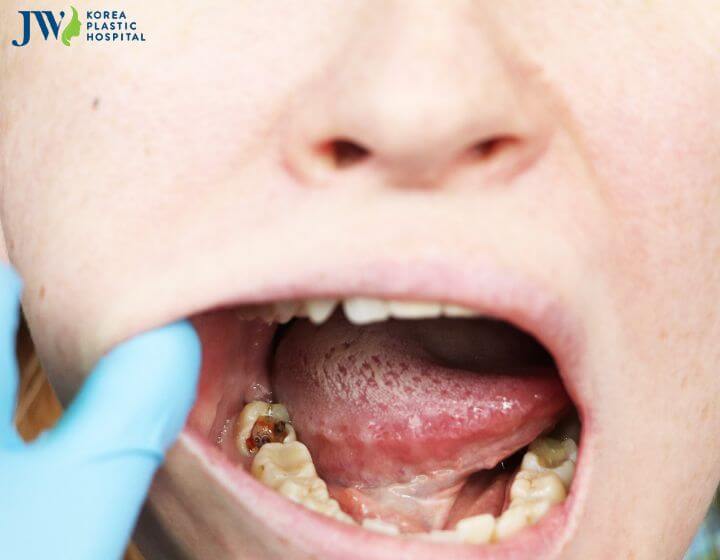 Nên điều trị sâu răng trước hay trong quá trình niềng? 1