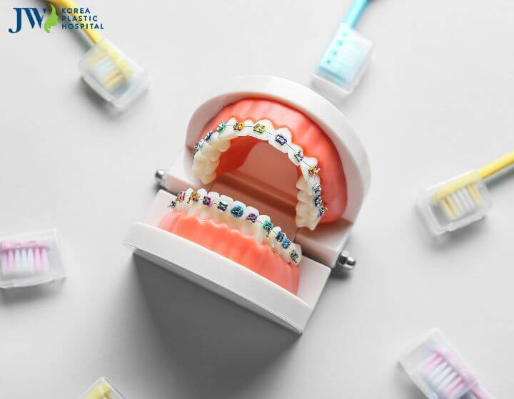 Nên điều trị sâu răng trước hay trong quá trình niềng? 2