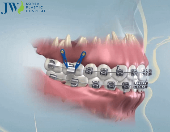 Niềng răng ảnh hưởng đến phát âm hay không?
