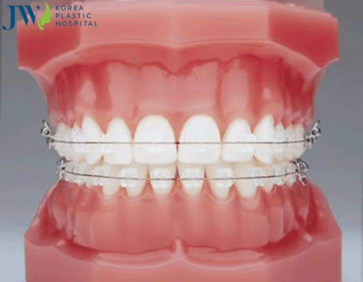 Niềng răng ảnh hưởng đến phát âm hay không?