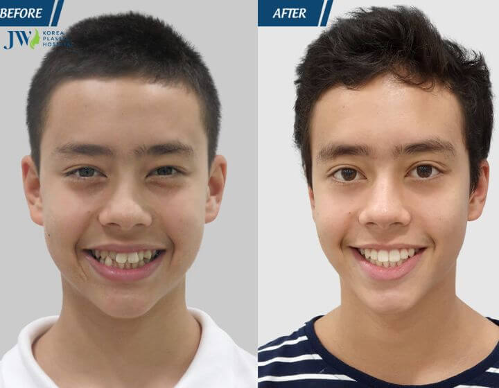 Niềng răng thay đổi góc hàm