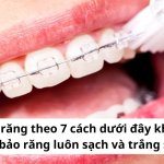Vệ sinh răng theo 7 cách dưới đây khi niềng đảm bảo răng luôn sạch và trắng sáng!